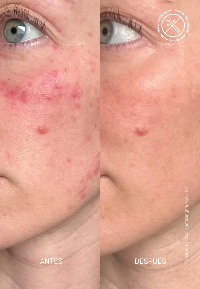 Ceramide Treatment - Image 9